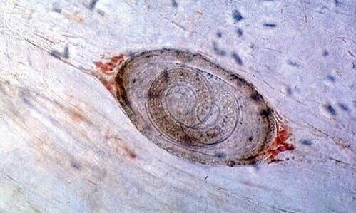 trichinella from the human body